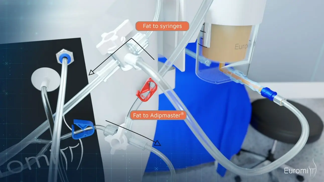 The Infiltration kit guides the fat